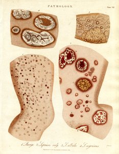 Pathologische Hautzustände: Schurigie; Leprahaut; Pallada und Impetigo