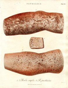 Hautausschläge - Roseola simplex und Roseola paristhmitica
