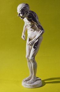 Figur einer Frau mit Parkinson-Krankheit von Paul Marie Louis Pierre Richer