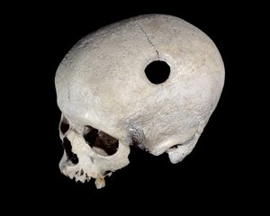 Prähistorischer Schädel mit Trepanationsspur, Museum für Nationalantiquitäten von Prehistoric Prehistoric
