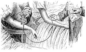 Bluttransfusion, ca. 1880