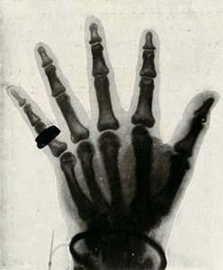 Röntgenaufnahme der Hand von H.R.H. Der Prinz von Wales