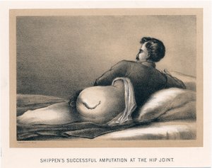 Shippens erfolgreiche Amputation am Hüftgelenk, Amerikanischer Bürgerkrieg, 1865