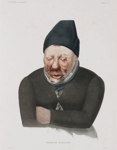 Krankheiten, Lepra von Unbekannt