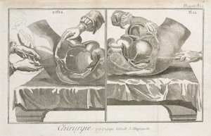 Ausrüstung, frühneuzeitliche Bauchchirurgie von Unbekannt