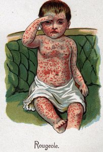 Kinderkrankheiten: Masern. In „Die neue Naturmedizin“ von F.E. Bilz