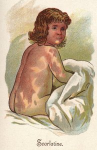 Kinderkrankheiten: Scharlach. In „The new natural medication“ von F.E. Bilz