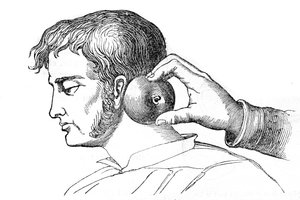 Lokale Blutegelbehandlung - Anwendung von Blutegeln mit einem Apfel - Gravur in „La Santé Universelle - Guide Médical des Familles“ 1852