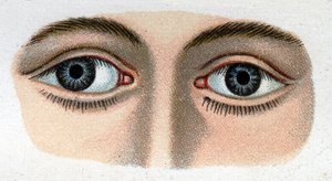 Divergenter Strabismus. „The new natural medication“ von F.E. Bilz von Unknown artist