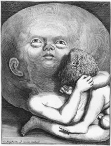 Monster: Kind mit Hydrozephalus, Anthropologie von Unknown artist