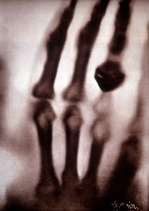 Röntgenstrahlen oder X-Strahlen Erstes Foto: die Hand von Röntgens Frau. 22.12.1895