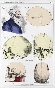 Studie über die Morphologie eines delinquenten Schädels durch den italienischen Kriminologen