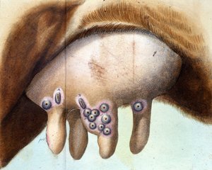 Die Brust der Kuh, die von Luigi Sacco (1769-1836) im Januar 1801 zur Pockenimpfung verwendet wurde. Medizinische Tafel aus „Vaccination Treat“ von Luigi Sacco, Mailand.