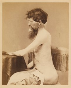 Private John Bar, Genesung nach einer Durchdringenden Bauchverletzung mit Bruch des Linken Os Innominatum, aus dem Fotografischen Katalog der Chirurgischen Abteilung von William Bell