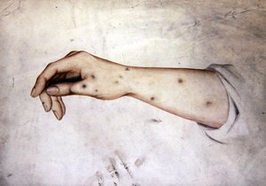 Studie eines Unterarms mit Hauterkrankung, ca. 1850
