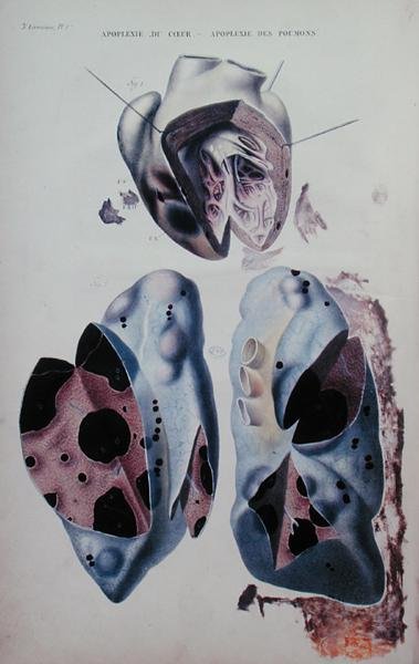 Herz- und Lungenapoplexie, Illustrationsplatte aus 