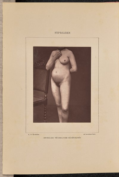 Generalisierte vesikulöse Syphilis von Arthur de Montmeja