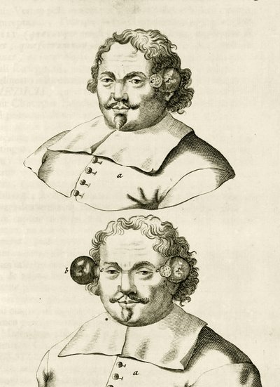 Ein Beispiel für Schröpfen, aus Exercitationes Practicae circa Medendi Methodum von Frederik Dekkers, 1694 von Dutch School