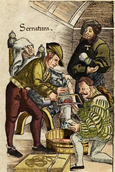 Amputation eines Gliedes von French School