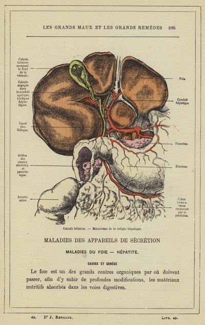 Gallensteine, Mechanismus der Gallenkolik von French School