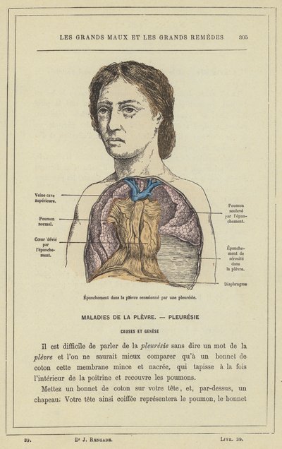 Erguss in die Pleura verursacht durch eine Pleuritis von French School