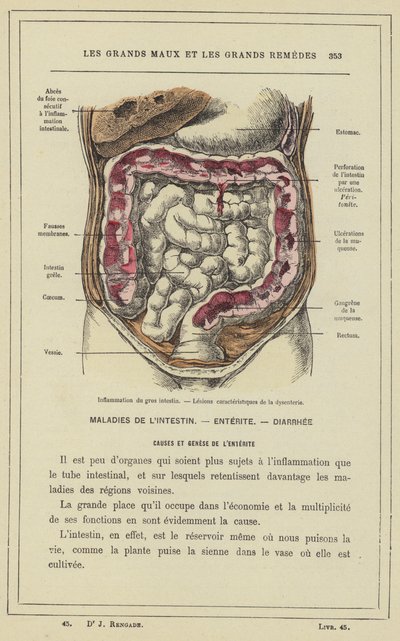 Entzündung des Dickdarms, Charakteristische Läsionen der Dysenterie von French School