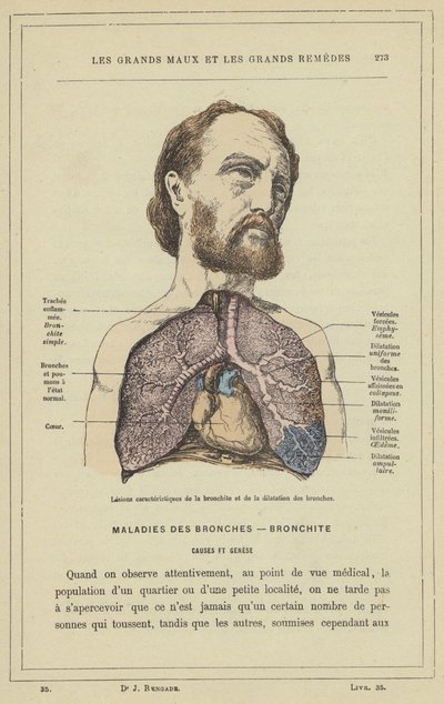 Charakteristische Läsionen der Bronchitis und der Bronchiektasie von French School