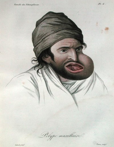 Maxillärer Polyp, aus einem Buch von Baron Jean Louis Alibert 1817 von French School