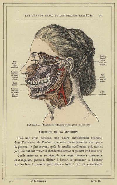 Zahnnerven, Mechanismus der Zahnschmerzen durch Karies von French School