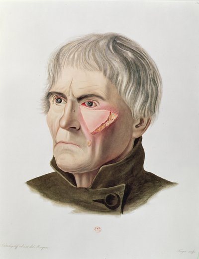 Hauttransplantationsoperation, aus Selecta Praxis Medico-Chirurgica von Alexander Auvert, Paris, 1856 von French School