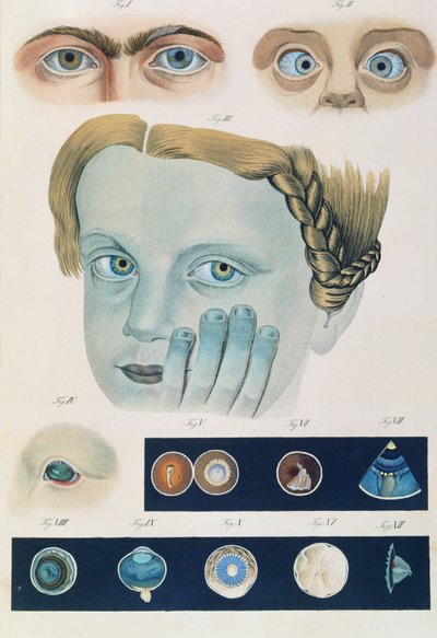Beschreibung angeborener Augenanomalien, aus Klinische Darstellungen der Krankheiten und Bildungsfehler des menschlichen Auges, von Friedrich August von Ammon (1799-1861) 1838 von German School
