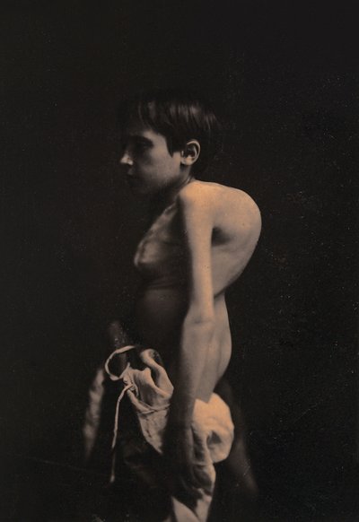Porträt eines buckligen Jungen von Guillaume Benjamin Armand Duchenne de Boulogne