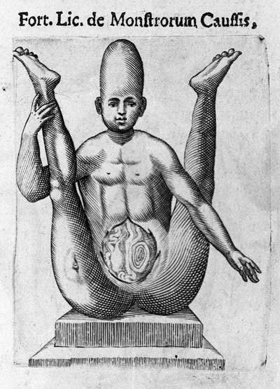 Menschliches Monster: eine Kreatur mit riesigem Schädel und sichtbaren Eingeweiden. Gravur aus „De monstrorum natura, causis et differentiis“ von Fortunio Liceti (1577-1656), italienischer Wissenschaftler. 1646 von Italian School