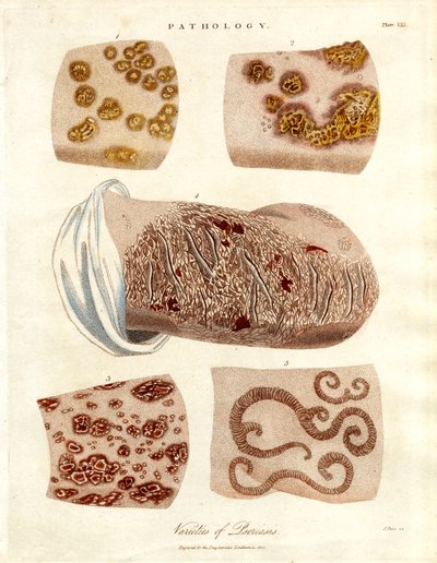 Pathologische Hautveränderungen: Varianten der Psoriasis von John Pass