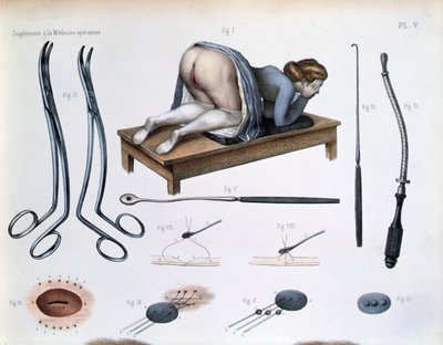 Eine Operation an einer vesikovaginalen Fistel, Tafel aus 