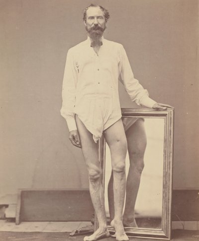 Schusswunde des mittleren Drittels des linken Oberschenkels von William H. Bell