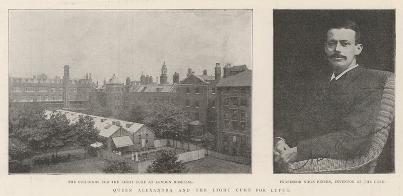 Königin Alexandra und die Lichttherapie gegen Lupus von English Photographer