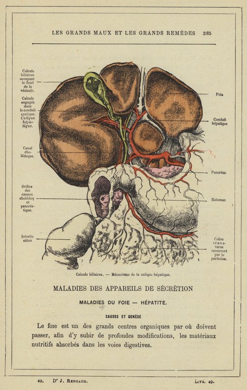 Gallensteine, Mechanismus der Gallenkolik von French School
