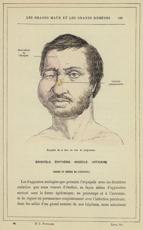 Fortschreitendes Gesichts-Erysipel von French School