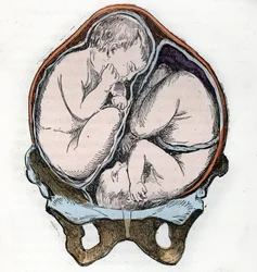 Darstellung der guten Lage zweier Föten während einer Zwillingsschwangerschaft. Stich aus „La nature et l