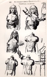 Operation bei Brustkrebs, aus „Armamentarium Chirurgicum“ von Johannes Schultes (1595-1645), veröffentlicht in Amsterdam, 1672
