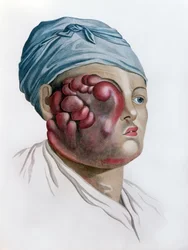 Krebsartige Skrofulose, aus Description des Maladies de la Peau von Baron Jean Louis Alibert (1768-1837) Paris, 1806