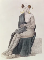 Kongenitale Ichthyose, aus einem Buch von G.M. Olbers, 1830