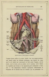 Seitliche Abweichung der Gebärmutter, die eine Befruchtung verhindert