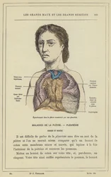 Erguss in die Pleura verursacht durch eine Pleuritis