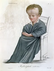 Interner Hydrozephalus, aus Nosologie Naturelle von Baron Jean Louis Alibert (1768-1837) graviert von Tresca, 1817