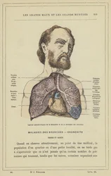 Charakteristische Läsionen der Bronchitis und der Bronchiektasie