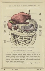 Charakteristische Läsionen der ulzerösen Gastritis, Magengeschwür