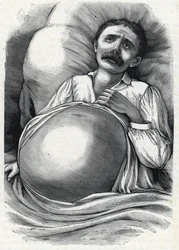 Patient mit fortgeschrittener Leberzirrhose (Gravur) 1888