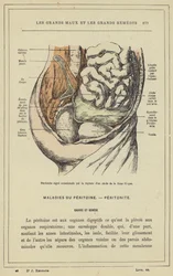 Akute Peritonitis verursacht durch den Bruch eines Abszesses in der Iliakalgrube
